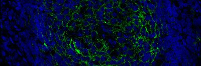 HumaHuman metastatic melanoma cells in a lymph node. ENPP1, a protein involved in immune evasion, is shown in green.n metastatic melanoma cells stained with anti-ENPP1 antibody (green).