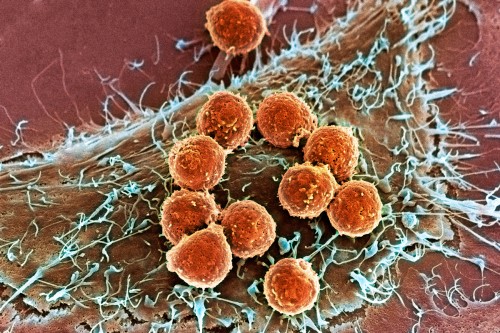Pictured: Immune system cells called T cells (orange) have detected a cancer cell and attached to it. Innovative drugs pioneered by Memorial Sloan Kettering researchers stimulate the ability of T cells to recognize and destroy cancer cells.